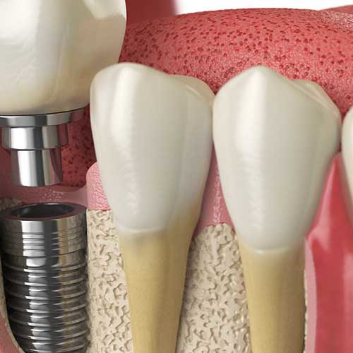 Dental Implants Teeth