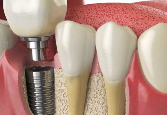 Dental Implants Teeth